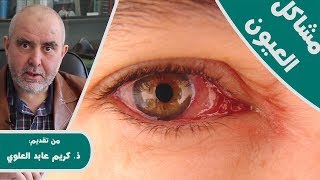 وصفات طبيعية لعلاج أمراض العيون (جفاف ,احمرار ,حكة و حساسية العيون) مع الدكتور كريم عابد العلوي