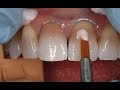 Masking the dark tooth with direct resin | DOTHANDSON