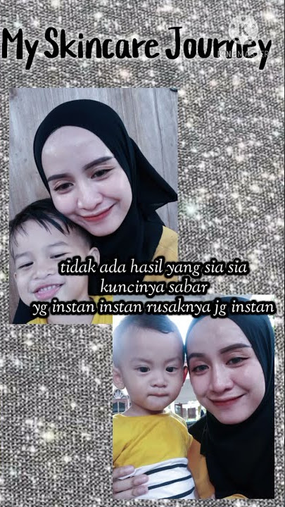 Jglow skincare | Lepas Cream abal abal | My acne journey | acne story