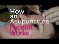 How an Acupuncture Facelift Works