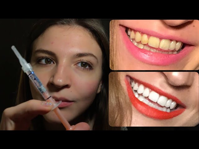 Dişlerimi nasıl evde beyazlattım? 🤩 Tüm Süreç Videolu Görüntüler İle -  YouTube
