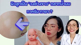 ผิวลูกเป็นวงด่างขาวเป็นขุย กลากน้ำนมเกลื้อนน้ำนม ทาครีมทายาอะไร|แม่โบNurse Kids