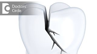 How to manage if Root Canal treated tooth gets fractured? - Dr. Jayaprakash Ittigi