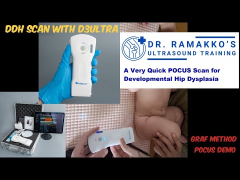 Infant hip, Graf method · POCUS · D3Ultra · Linear probe scan preview