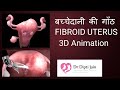 3d animation of uterine lump fibroid uterus  gynecologist dr dipti jain ahmedabad