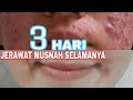 Cara Menghilangkan Jerawat Batu Dan Bekasnya