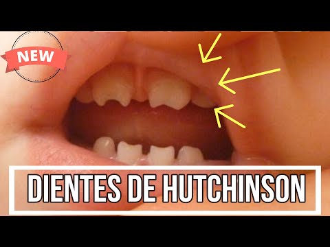 Vídeo: Dientes De Hutchinson: Imágenes, Causas, Tratamiento, Prevención