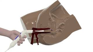 Using the Pocket Colposcope [Spanish Audio]