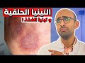 Dermatophytosis Ringworm Or Tinea Cruris Causes And Treatment The Answer To Resistance 