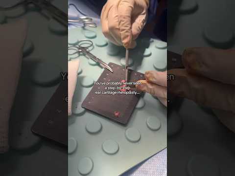 Video thumbnail: A natural, long-lasting alternative to nose filler 🤯 · Albert Plastic Surgery New York