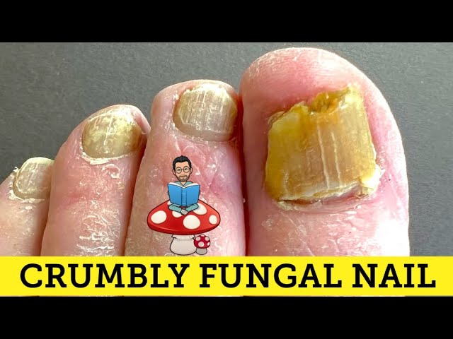 FUNGAL NAILS