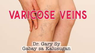 Varicose Veins