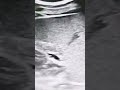 Splenic Lymphoma | infarcts Mass | Splenomegaly | Liver Cirrhosis | Hepatitis | Doppler Ultrasound