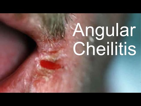 Video: Cheilitis Huulilla - Luokittelu, Hoito