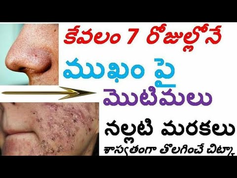 Acne blackheads cure in  days ! మొటిమలు నల్లటి మరకలు కేవలం రోజుల్లో నే కనబడకుండా చేసే గృహ చిట్కా