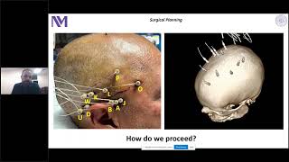 Vasileios Kokkinos, PhD - Interpretation of the hippocampal intracranial EEG