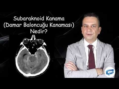 Anevrizmal Subaraknoid Kanama (Beyinde Damar Baloncuğu Kanaması) Nedir?