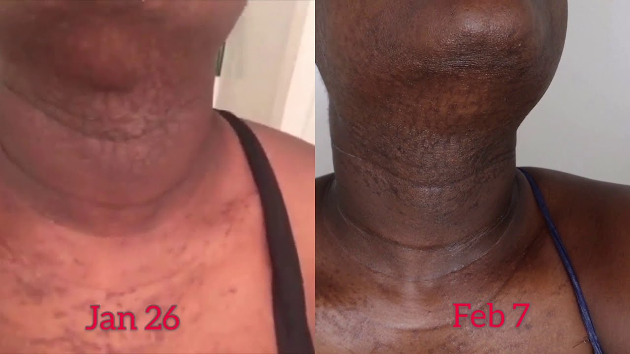 TINEA VERSICOLOR TWO WEEK UPDATE ON DARK SKIN YouTube