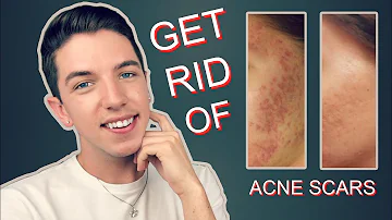 How do you get rid of acne holes?