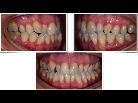 Invisalign. Apiñamiento muy