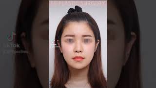 에프오성형외과 | 튀어나온 광대 울퉁불퉁해보이는 얼굴라인 고민에요