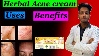 herbal acne cream | How to uses Herbal Acne Cream | acne cream | Uses,benefits, review पूरी जानकारी