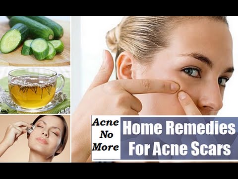 Natural Remedies for Acne and Pimples - Permanent Solution