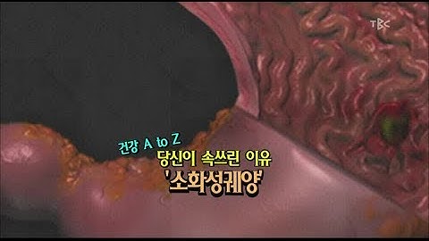 [TBC클리닉 건강365]당신이 속쓰린 이유 소화성궤양
