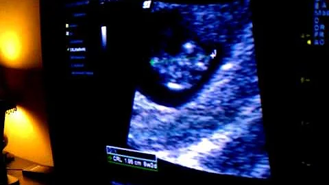 Charles Martinez & Joann Narvaez Ultra Sound @ 8 w...