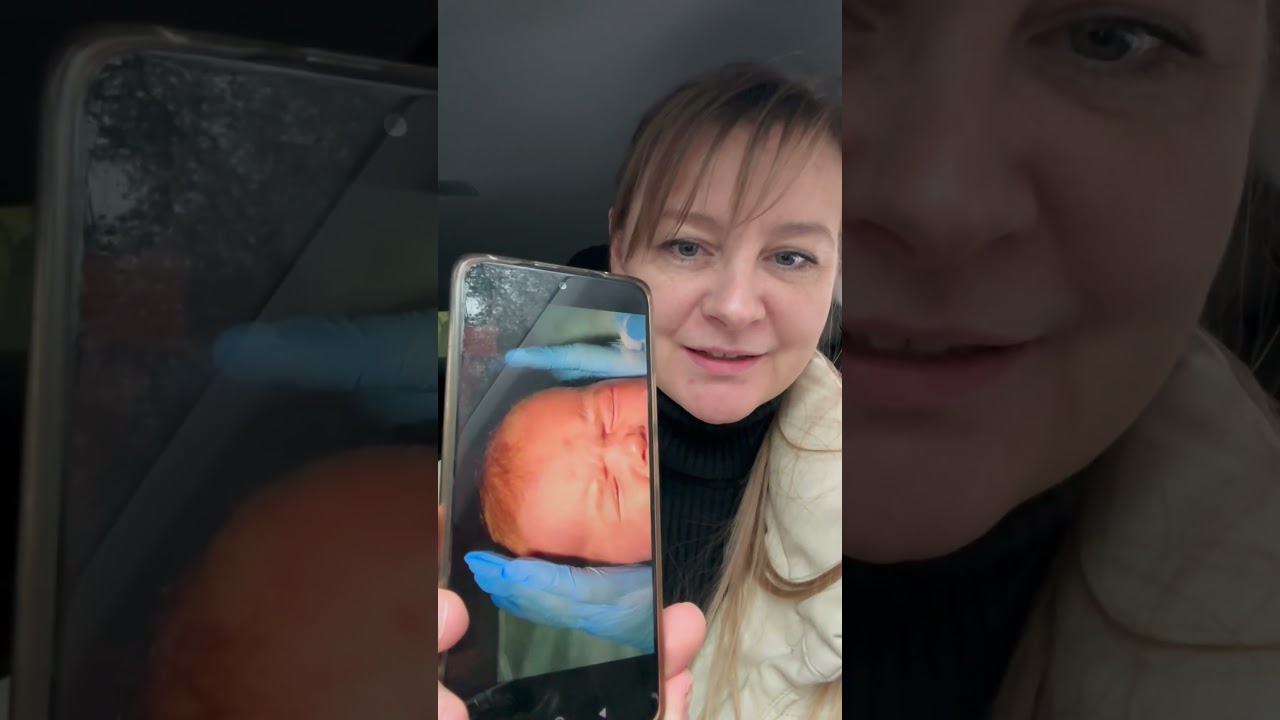 Как делается зондирование #офтальмолог #здоровье #зрение #окулист #очки #линзы #рецепты #глаза