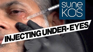 How To Inject Under Eyes With Sunekos (pigmentation, texture, wrinkles)