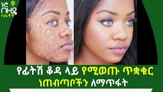 የፊትሽ ቆዳ ላይ የሚወጡ ጥቋቁር ነጠብጣቦችን ለማጥፋት የሚረዱሽ የቤት ውስጥ መላዎች