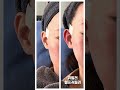 귀필러 대한민국에서 최고인 이다클리닉 허선녕입니다.#귀필러 #누운귀필러 #엘프귀 #엘프귀필러 # 귀성형