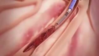 ऑपरशण इन हट