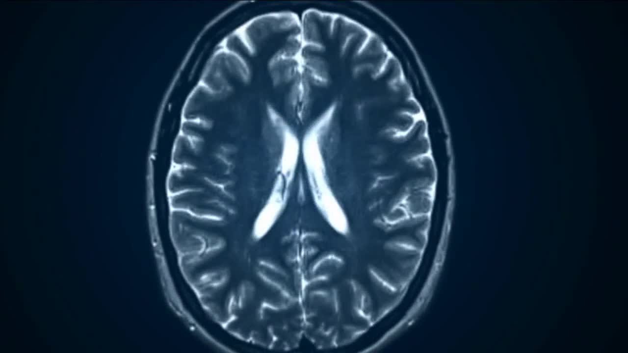 Doctor gets TMS approved for teens