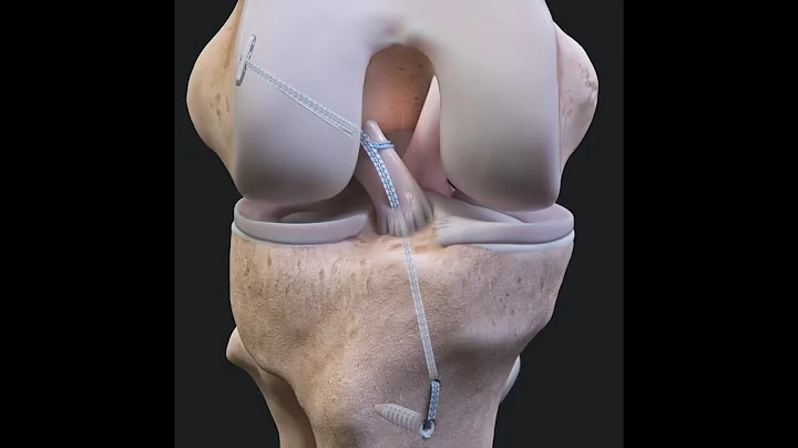 ACL Repair FAQs ACLTear.com