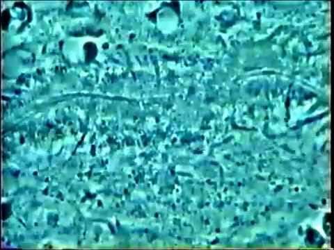 Parodontite et entamoeba gingivalis : expliquez moi Dr ? Amibe c&#039;est quoi ? Dans la gencive ?