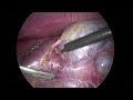 DISSECTION OF THE GALLBLADDER FROM THE LIVER BED IN DIFFICULT CASE