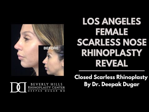 Video thumbnail: Los Angeles Female Scarless Nose Rhinoplasty Reveal with Dr. Deepak Dugar MD, Beverly Hills · Dr. Deepak Dugar | Scarless Nose Rhinoplasty