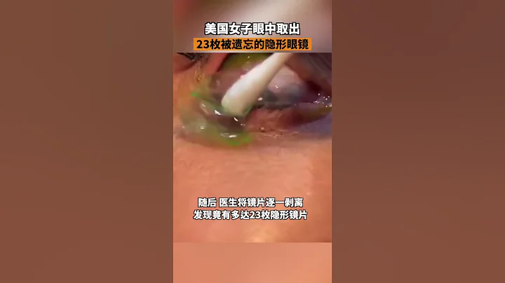 女子眼中取出23枚隱形眼鏡近日，美國一位醫生讓患者的眼球轉動時，看到一大團隱形眼鏡，醫生用棉簽把鏡片剝開，發現竟然有多達23枚隱形鏡片。 - 天天要聞