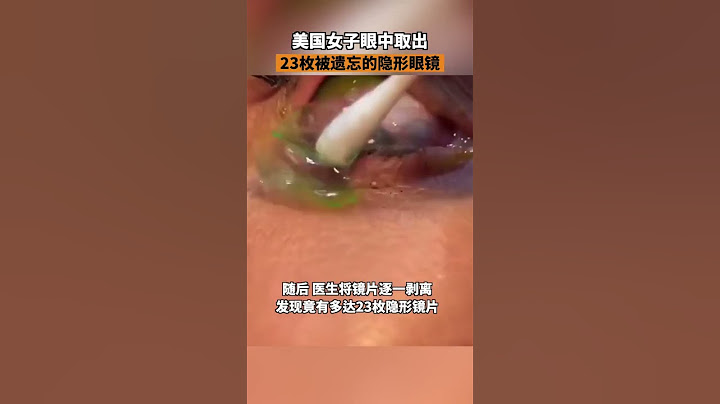 女子眼中取出23枚隱形眼鏡近日，美國一位醫生讓患者的眼球轉動時，看到一大團隱形眼鏡，醫生用棉簽把鏡片剝開，發現竟然有多達23枚隱形鏡片。 - 天天要聞