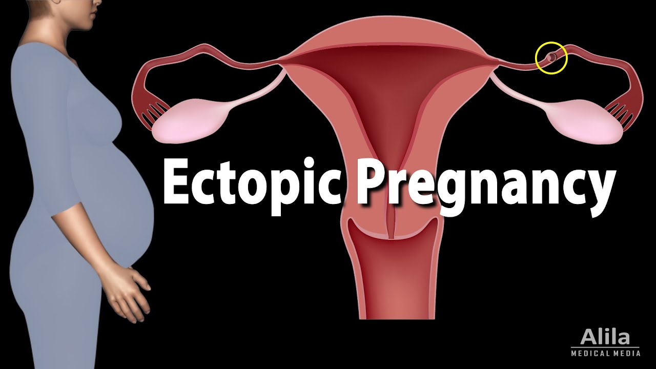 Ectopic Pregnancy Animation