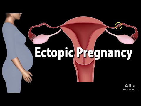 Wideo: Ciąża pozamaciczna