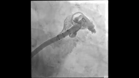 Stroke Risk Reduction