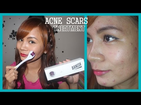 Needles on your face?! ACNE SCARS Treatment using Derma Roller!! ♥ ♥