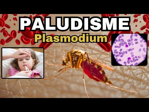 Vidéo: Comment reconnaître les symptômes du paludisme : 9 étapes (avec photos)