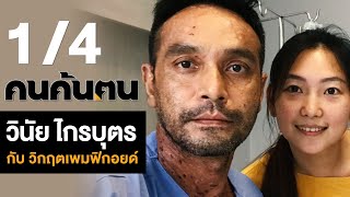 คนค้นฅน : วินัย ไกรบุตร กับ วิกฤตเพมฟิกอยด์ ช่วงที่ 1/4  (1 ก.ย.62)