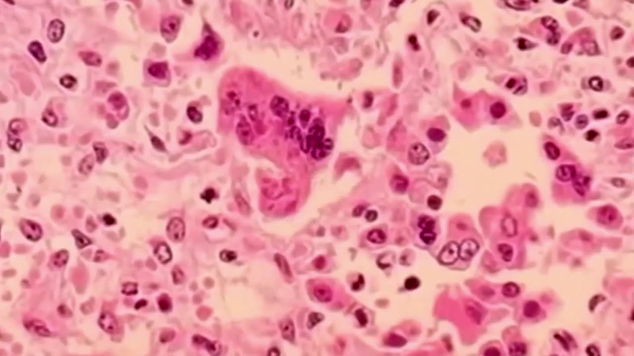 What to know amid the Texas measles outbreak | NBC4 Washington - YouTube