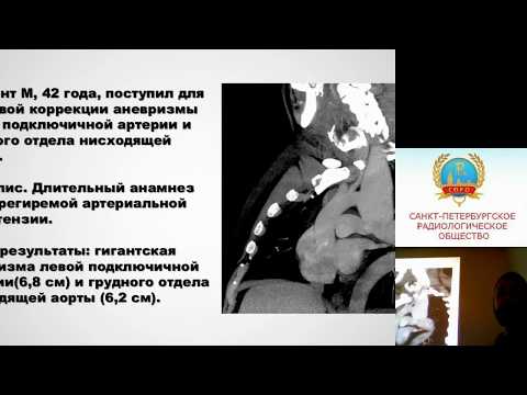 Стрелков Д.А. Эндоваскулярная коррекция гигантской аневризмы аорты