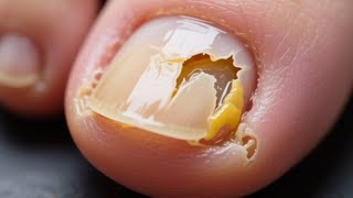 видео: Онихолизис ногтей — причины, лечение и опасные ошибки картинка: Онихолизис ногтей — причины, лечение и опасные ошибки